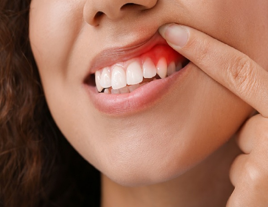 Healthy Gums and Preventing Periodontal Disease