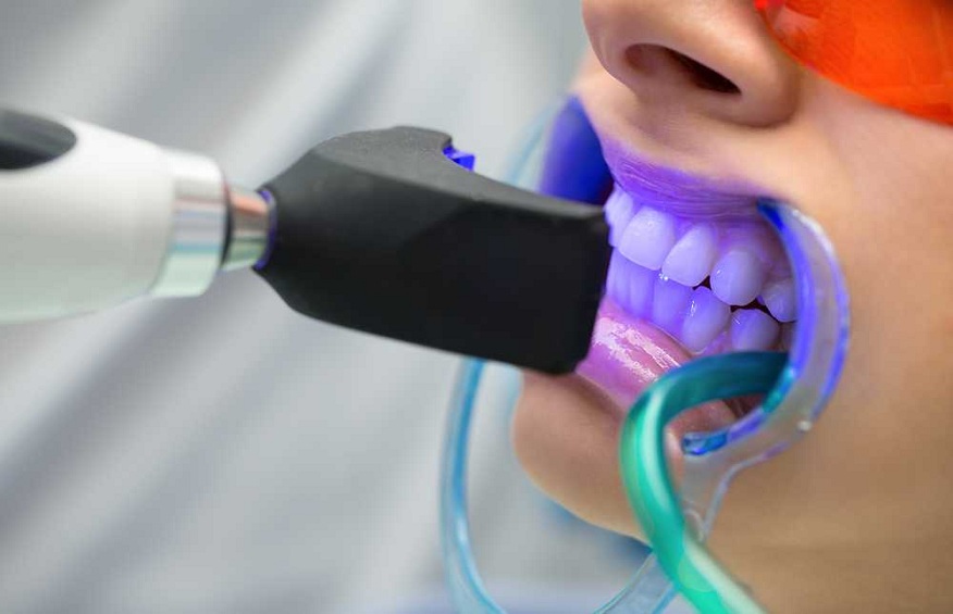 The Benefits of Teeth Whitening Procedures