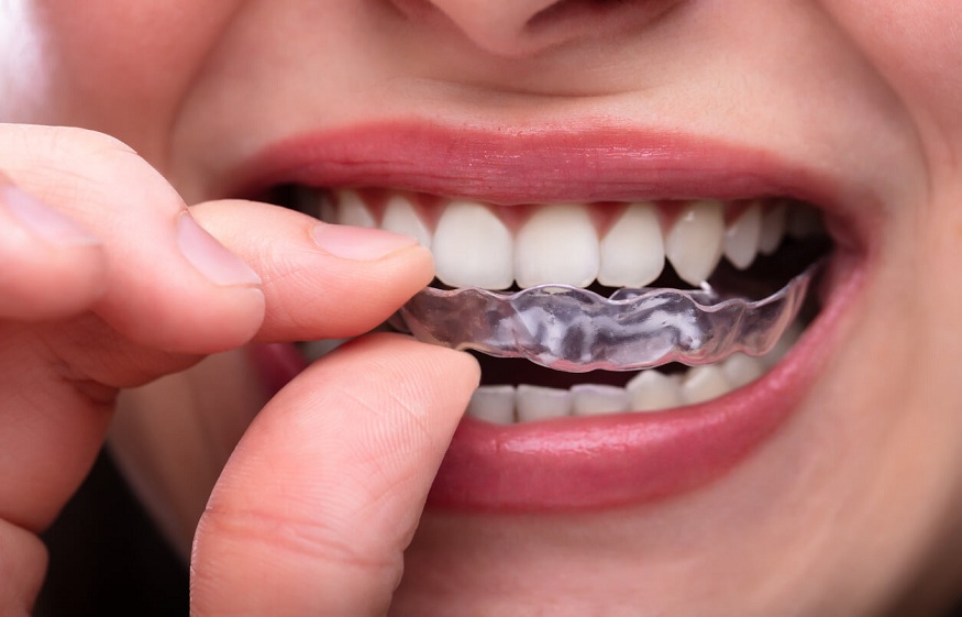 Explanation of Bruxism and Why You Should Prevent It.