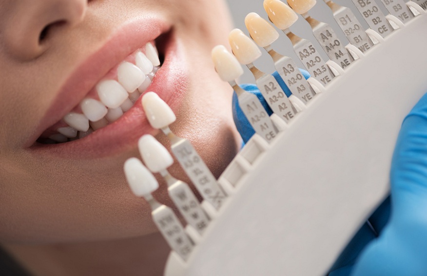 Elevating Smiles: Essential Teeth Whitening Advice in Bangkok
